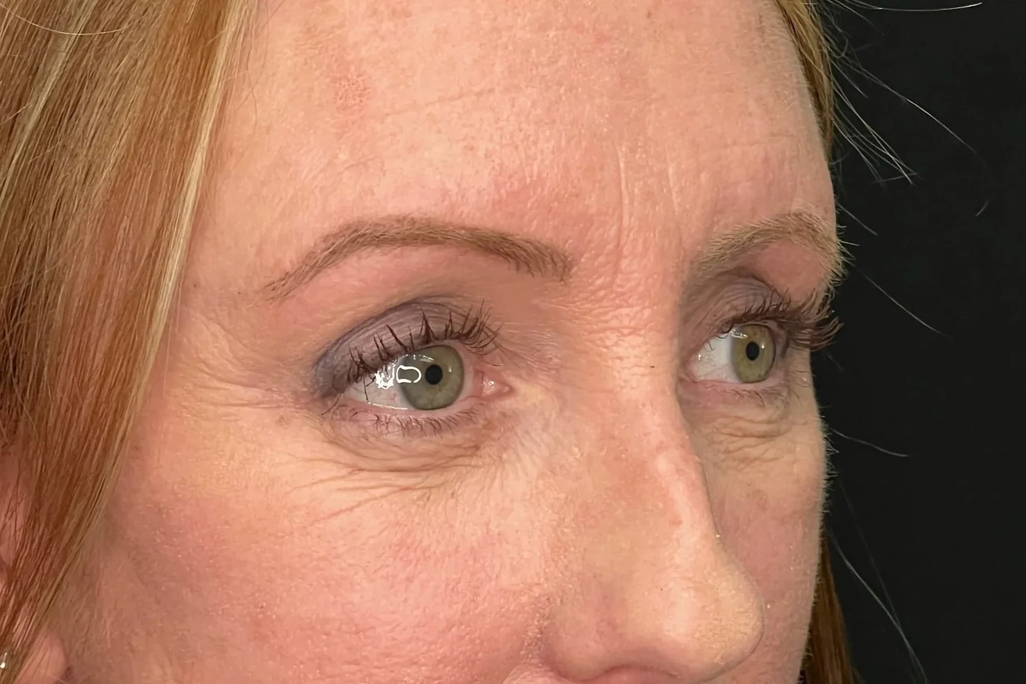 Close-up of a patient’s eyes and brow, photographed at a three-quarter angle against a dark studio backdrop.