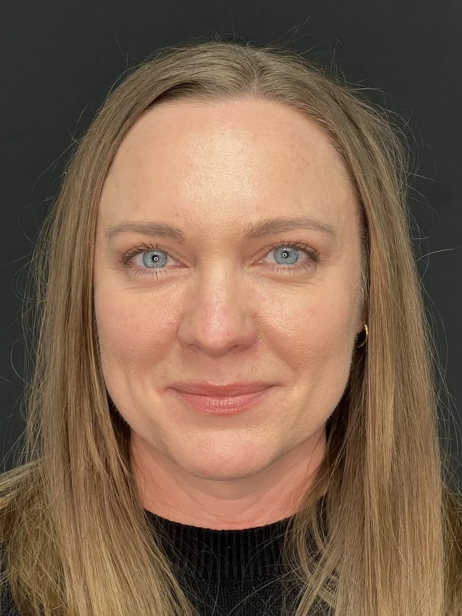 Front-facing studio portrait of a patient, showing the eyelids and upper face, against a dark backdrop.