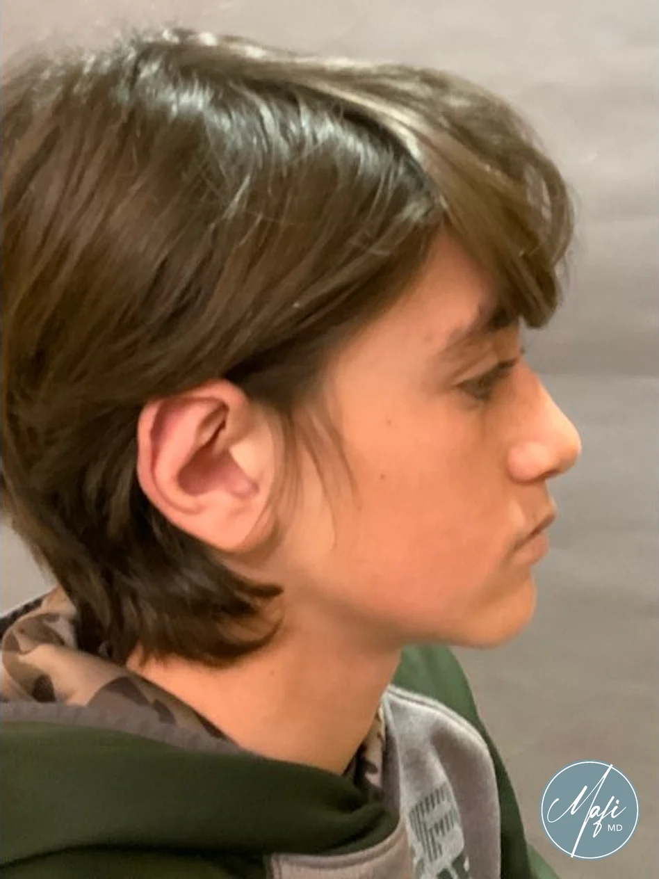 Side profile of a patient after otoplasty, the ear sitting close to the head