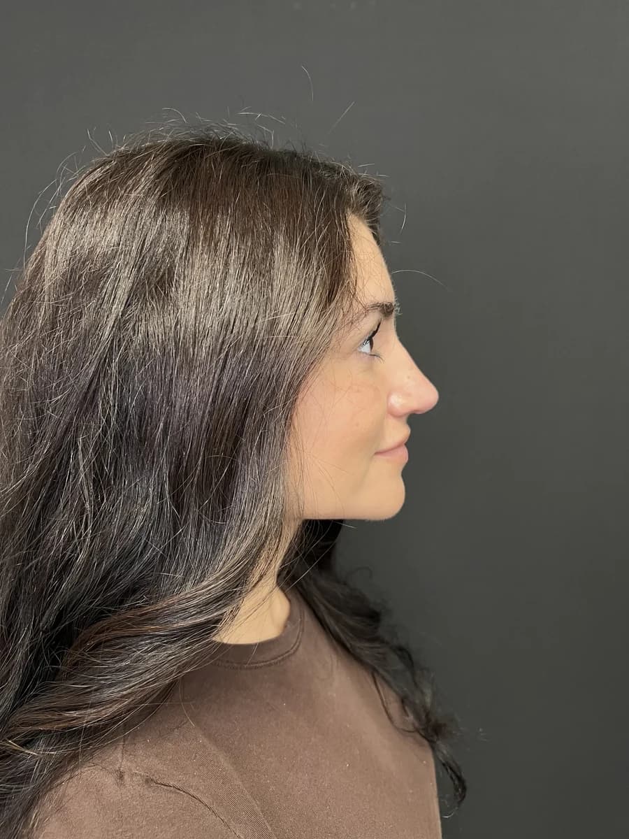 Side profile of a rhinoplasty patient of the practice, showing the bridge and tip of the nose against a charcoal studio backdrop