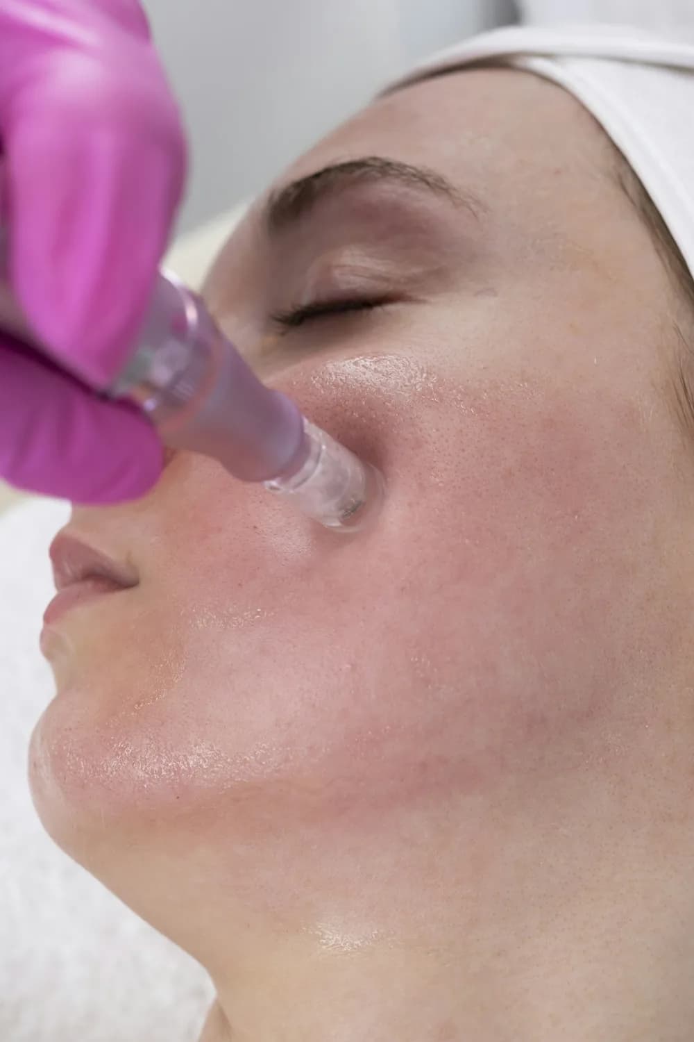Microneedling at Mafi Plastic Surgery