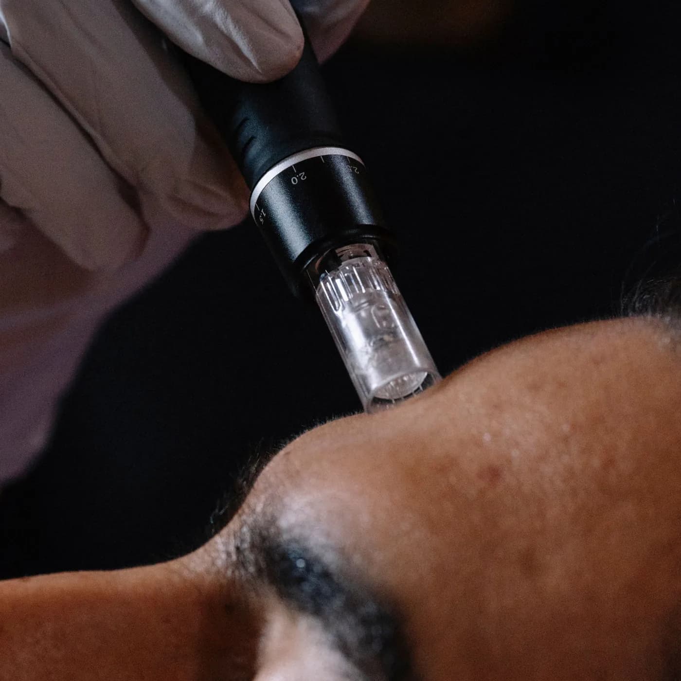 A microneedling pen held to a patient’s brow, close up