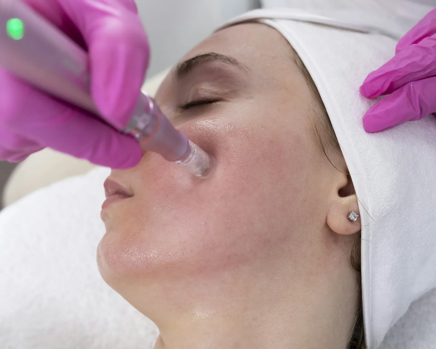 A microneedling pen drawn across the cheek of a patient reclined for treatment