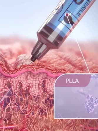 Medical illustration of a syringe delivering poly-L-lactic acid microparticles beneath the surface of the skin