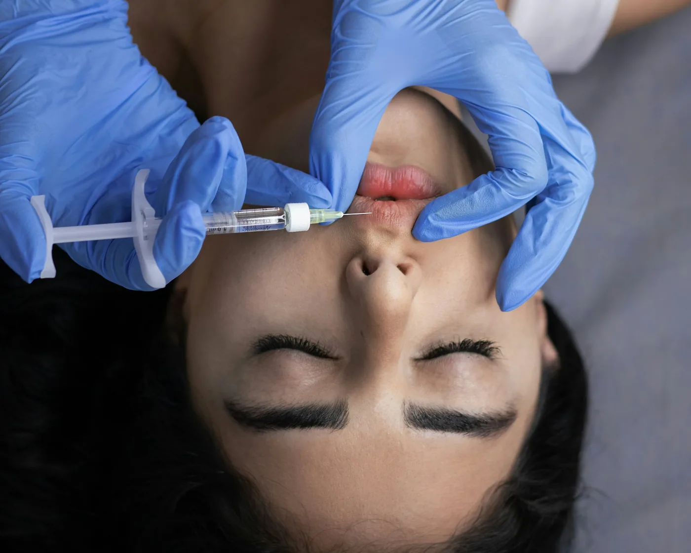 Gloved hands placing soft tissue filler in the lip of a reclined patient with her eyes closed