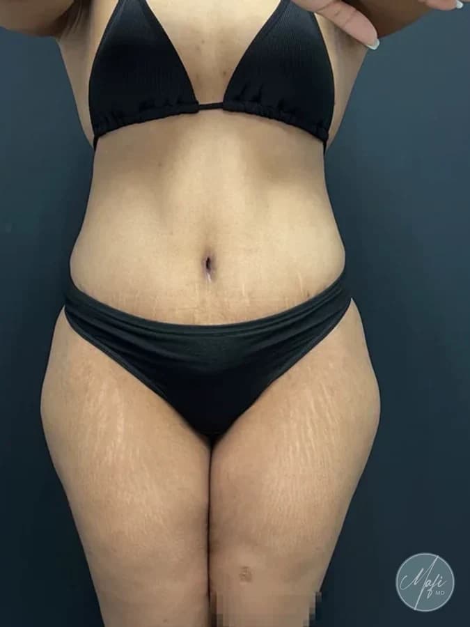 Abdominoplasty at Mafi Plastic Surgery