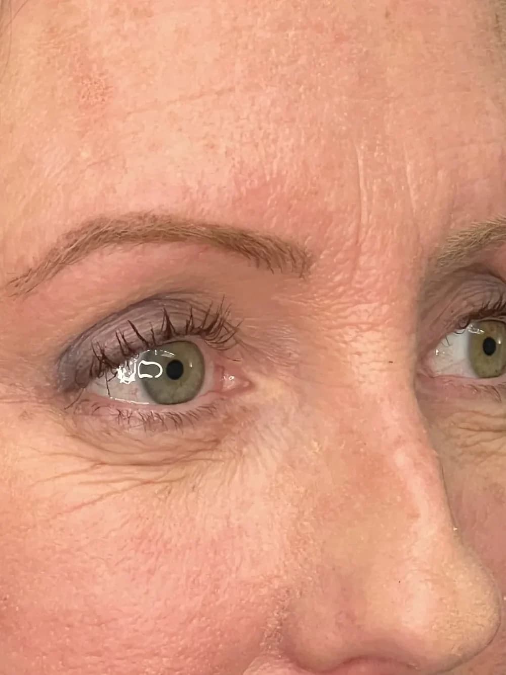 Blepharoplasty at Mafi Plastic Surgery