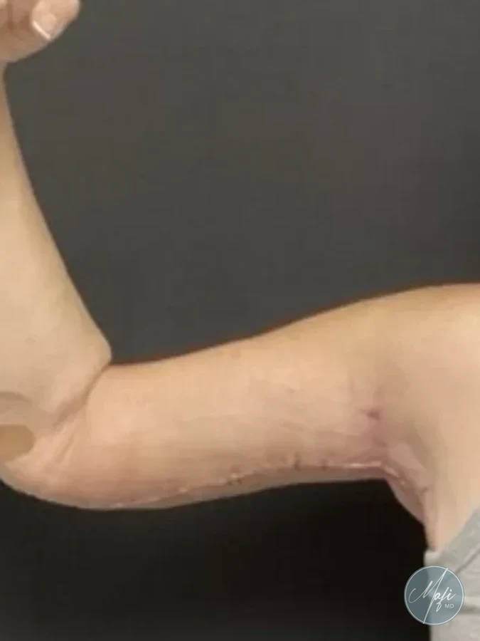Brachioplasty at Mafi Plastic Surgery