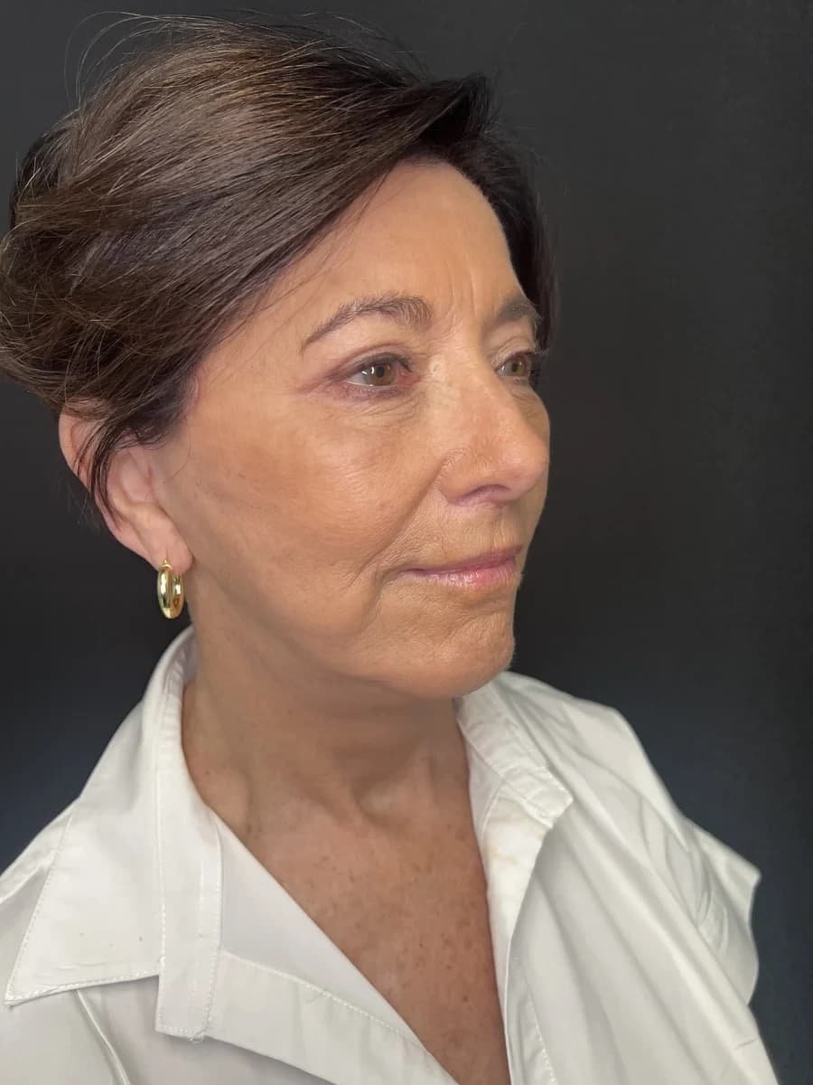 Brow Lift at Mafi Plastic Surgery