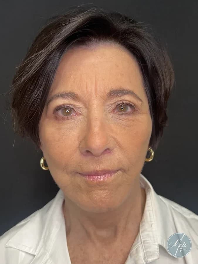 Facelift at Mafi Plastic Surgery