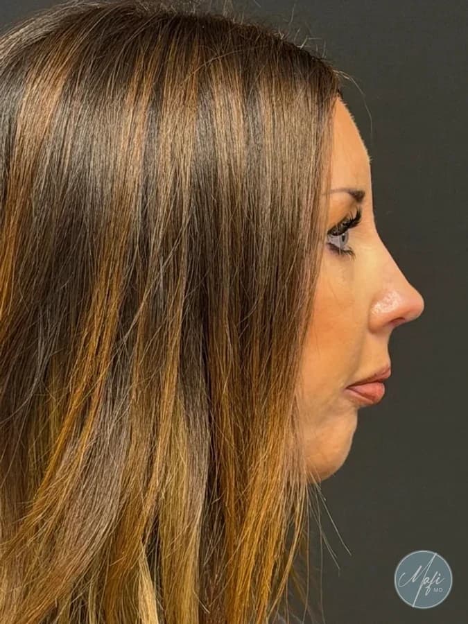 Rhinoplasty at Mafi Plastic Surgery