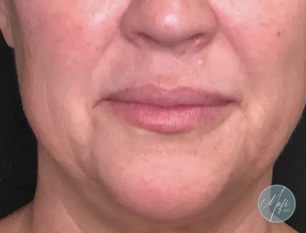 Before: an injectable patient of Jessica Massed, FNP