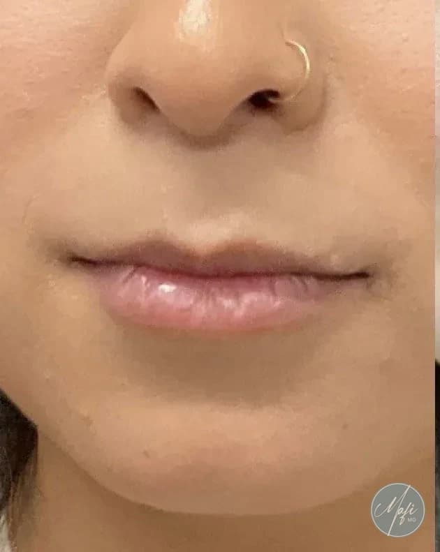 Before: an injectable patient of Justine Kinzel-Eckman, FNP