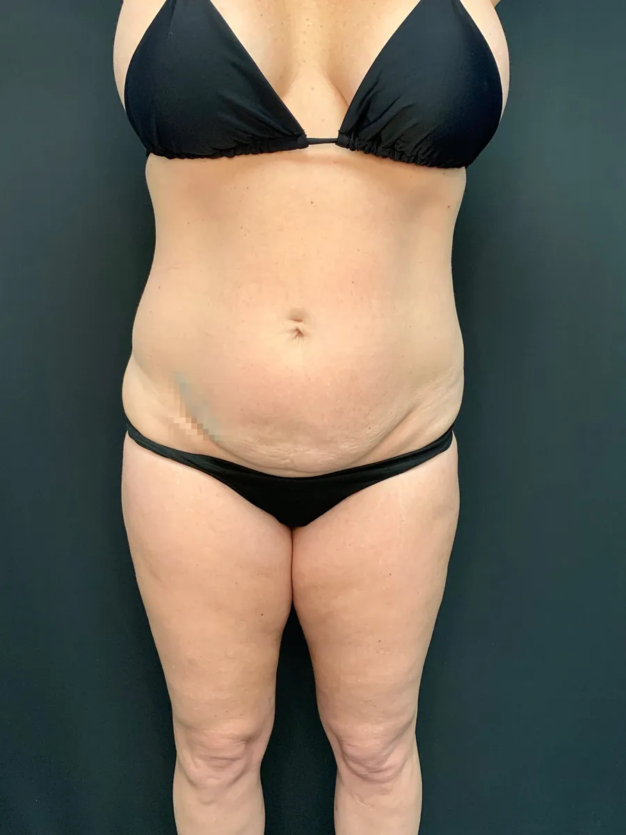 Before: an abdominoplasty patient of Dr. Mafi