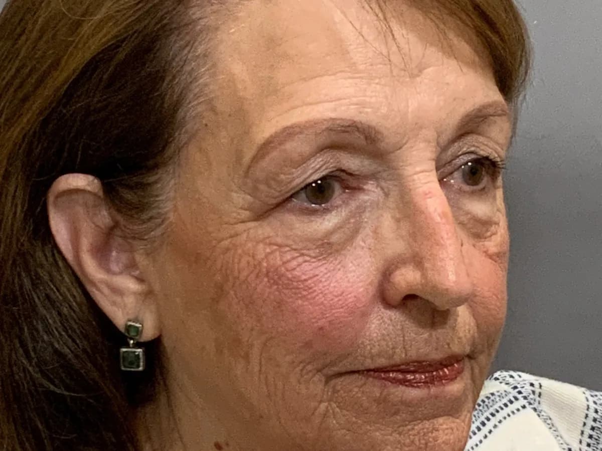 Before: a blepharoplasty patient of Dr. Mafi