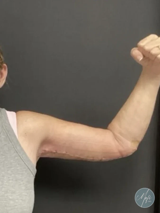 A brachioplasty patient of the practice, arm raised after surgery