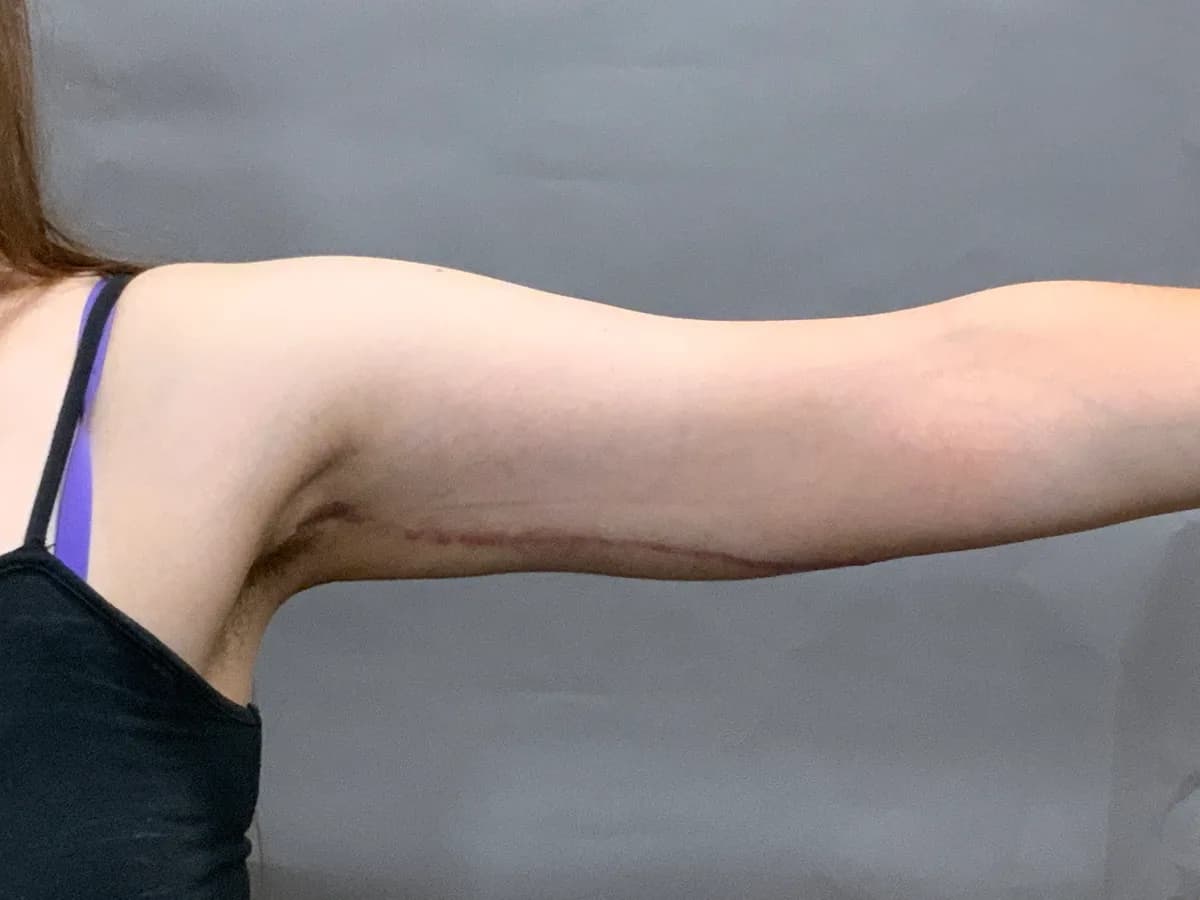A brachioplasty patient of the practice, arm extended after surgery