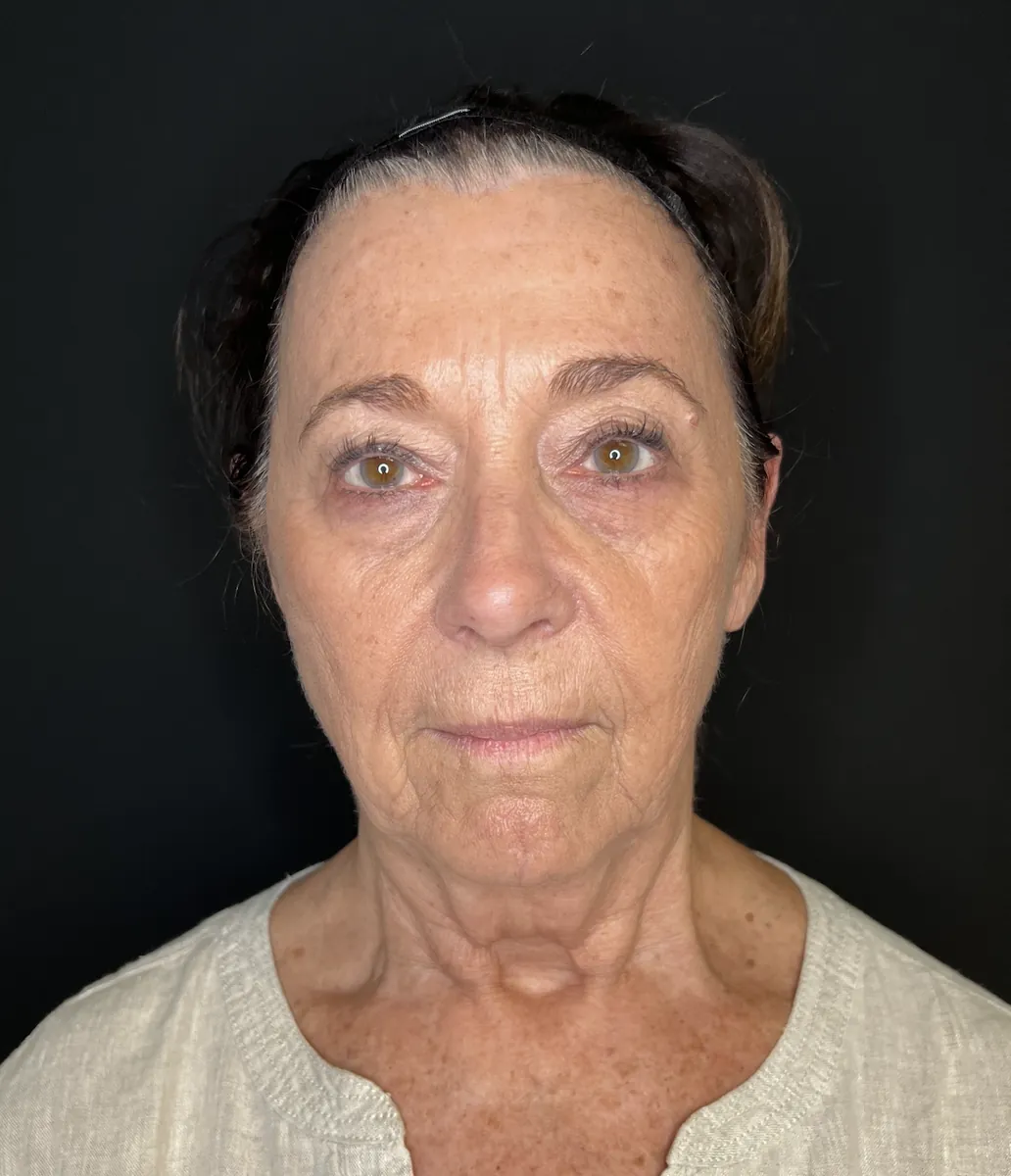 Before: a facelift patient of Dr. Mafi