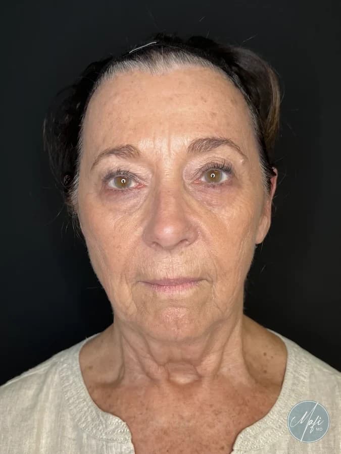 Before: a facelift patient of Dr. Mafi