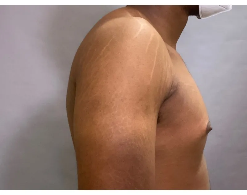 Before: a gynecomastia patient of Dr. Mafi