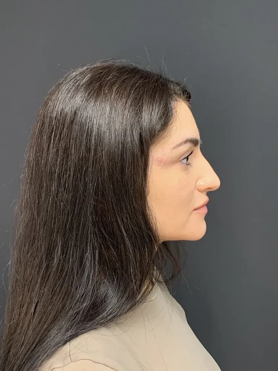 Rhinoplasty, before