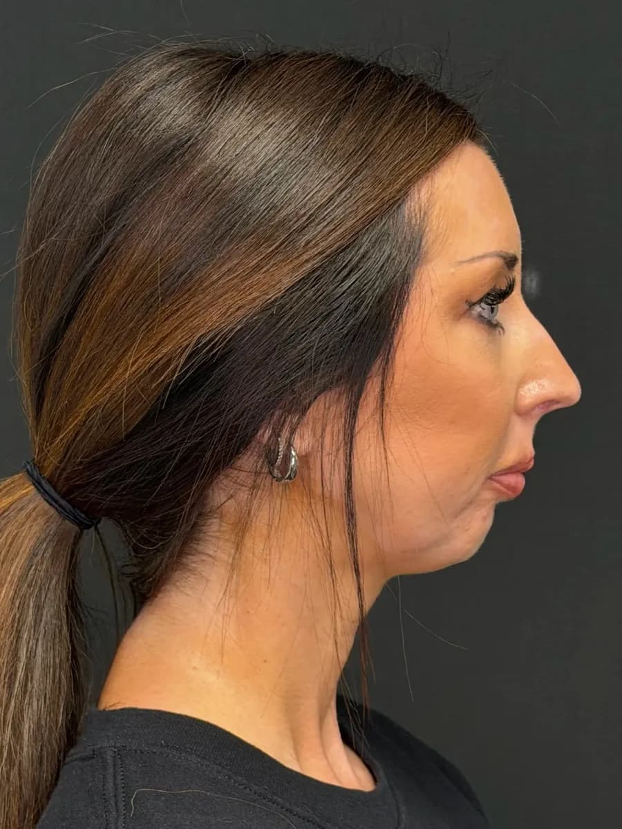 Rhinoplasty Plus Small Chin Augmentation Using Silicone Implant, before