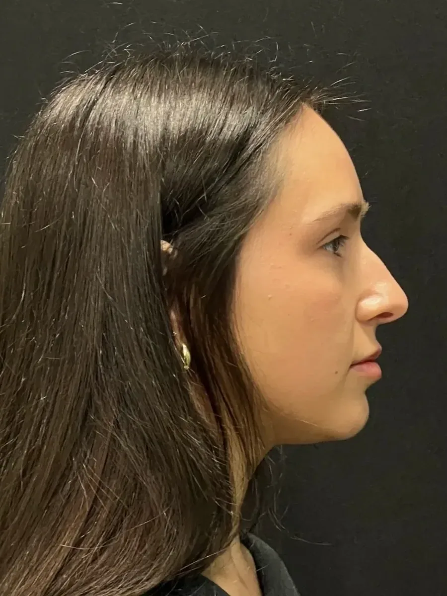 Rhinoplasty, before